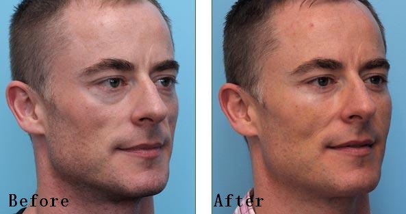 미국에서 은근히 많이하는 성형수술 세가지 | 인스티즈