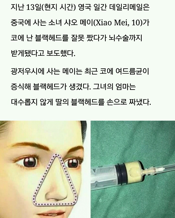 '위험 삼각형' 부분에 난 '블랙헤드' 짰다가 뇌종양 생긴 10세 소녀 | 인스티즈
