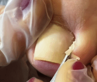 쾌감 오지는 내성발톱 제거 움짤ㄷㄷㄷㄷㄷㄷ. gif (혐오주의) | 인스티즈